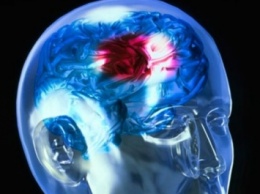 Ученые выяснили, что помогает мозгу восстановиться после инсульта