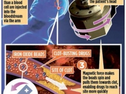 Ученые: Магнитная кровь спасет от последствий инсульта