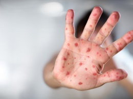 Опасная инфекция атакует украинцев: прививки не помогают