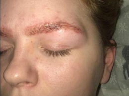 Студентка в Великобритании госпитализирована с ожогом после окрашивания бровей