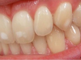 О чем говорят белые пятна на зубах?