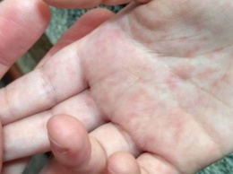 Не прививали по религиозным причинам: В Запорожской области шестеро детей заболели корью