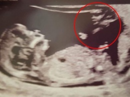 В Британии женщина, которая чудом забеременела, увидела на снимке УЗИ ''ангела-хранителя''