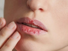 Сухие губы: иногда за этим стоит серьезная болезнь