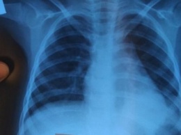 «Мне их некуда ложить!»: врачи Запорожья обеспокоены волной пневмонии