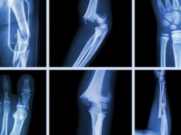 Датский стартап разработал технологию печати индивидуальных протезов костей