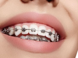 Как правильно есть после установки брекетов: ответ стоматолога