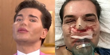 Хирурги спасли нос "живого Кена", заменив хрящ на трансплантат из его ребра