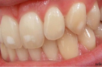 О чем говорят белые пятна на зубах?