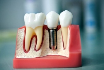 Удаление зубов мудрости: особенности процесса
