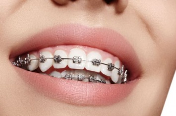 Как правильно есть после установки брекетов: ответ стоматолога