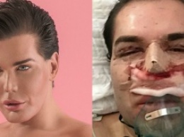 После 42-ой операции мужчина, который хотел стать "живым Кеном", почти лишился своего носа
