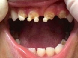 Когда врач увидел зубы 3-летнего ребенка, он задал матери всего один вопрос
