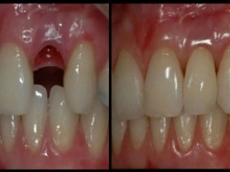 Вырастить новые зубы за 9 недель: процедура, которая возможна в любом возрасте!