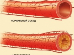 Лишь 50 мл в день этого мощного напитка очищают артерии и предупреждают сердечный приступ!