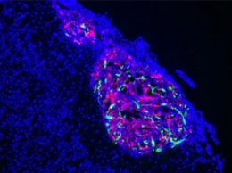 Ученые обнаружили эффективный способ борьбы с раком мозга