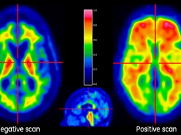 Новый препарат может остановить потерю памяти при болезни Альцгеймера