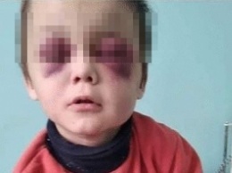 «Из-за гематом не мог открыть глаза»: на Винничине родители жестоко избили ребенка (Фото)