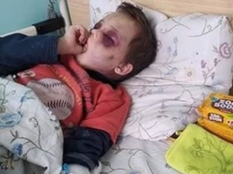 В Винницкой области с побоями госпитализирован шестилетний ребенок