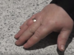 Запорожская пенсионерка могла умереть из-за кольца на пальце - видео
