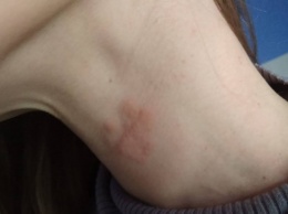 Странную инфекцию обнаружили у подростка из Харьковской области