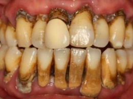 Плохое состояние зубов значительно повышает риск развития онкологии