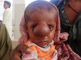 В Пакистане родился ребенок мозговой грыжей на лице