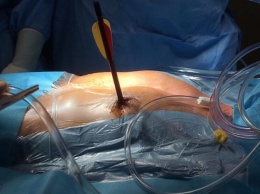 В Италии кардиохирурги спасли мужчину, которому в сердце попала 30-сантиметровая арбалетная стрела (ФОТО)
