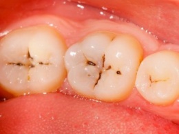 Последствия зубного кариеса и его лечение