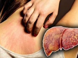 Желтые белки и сыпь на коже: Названы главные признаки болезни печени