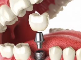 Зубные протезы или импланты?