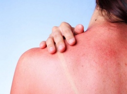 Никаких народных средств: дерматолог рассказал, как правильно лечить солнечные ожоги