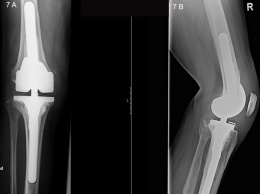 Онлайн-тест предскажет успех операции по замене коленного сустава