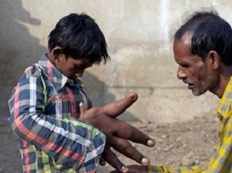 Врачи помогли индийскому мальчику с гигантскими руками