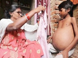 Загадочная болезнь превращает тело мужчины из Индии в огромный шар