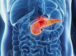 Низкий уровень сахара в крови может быть ранним симптомом рака поджелудочной железы