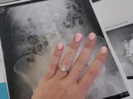 Девушка "съела" кольцо, пряча его от воров из сна (фото)
