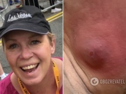 Дыра в руке: в Британии женщина попала в больницу после укуса паука