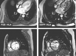 Нейросеть анализирует МРТ сердца эффективнее, чем эксперты