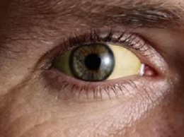 О чем сигнализируют желтые белки глаз
