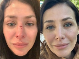 Получившая травму носа актриса Волкова рискует остаться со шрамом