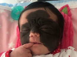 Мама девочки с родимым пятном в виде «маски Бэтмена» поблагодарила россиян