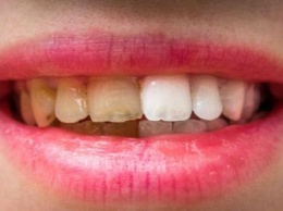 Дантист не нужен: Как легко отбелить зубы на дому