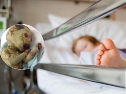 Малыша с редким ''синдромом вампира'' бросили в больнице: фото