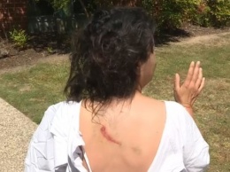 В Австралии девушке наложили 25 швов после нападения кенгуру
