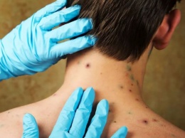 Сыпь на коже: какие болезни могут скрываться за ней?