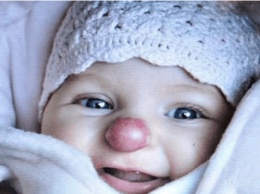 Девочка родилась с «клоунским» носом: как она выглядит через 3 года. ФОТО