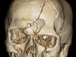Полная реконструкция: в Мечникова собрали по кусочкам череп травмированного рабочего