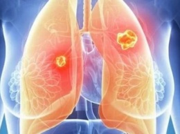 Рак легких: три необычных признака на лице