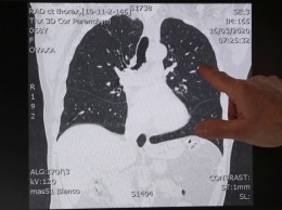 Коронавирус: как вирусная пневмония поражает легкие и приводит к смерти